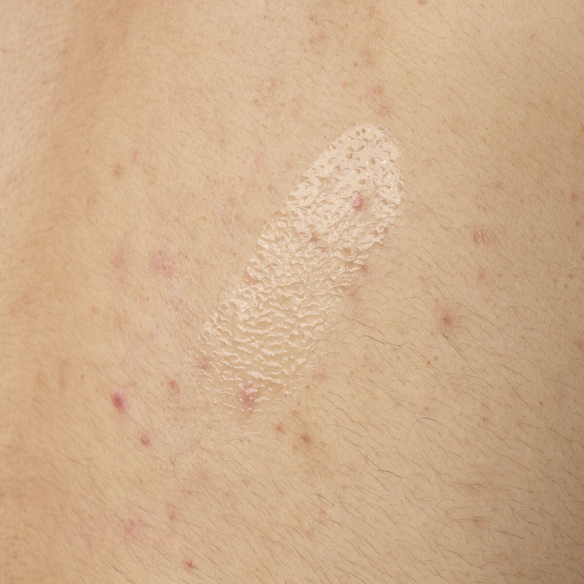 salicylic-acid-0-5-body-serum-y5 ORD-salicylic-acid-05-body-240ml-application.jpg