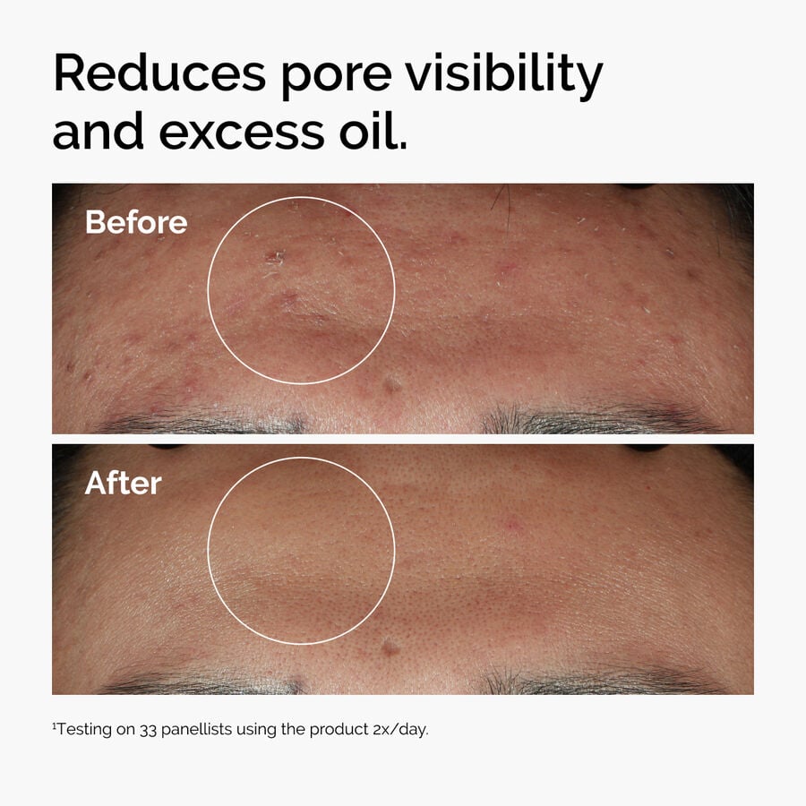 niacinamide-10-zinc-1-q0 ord-niacinamide-zinc-blemish-serum-before-after-pores.jpg