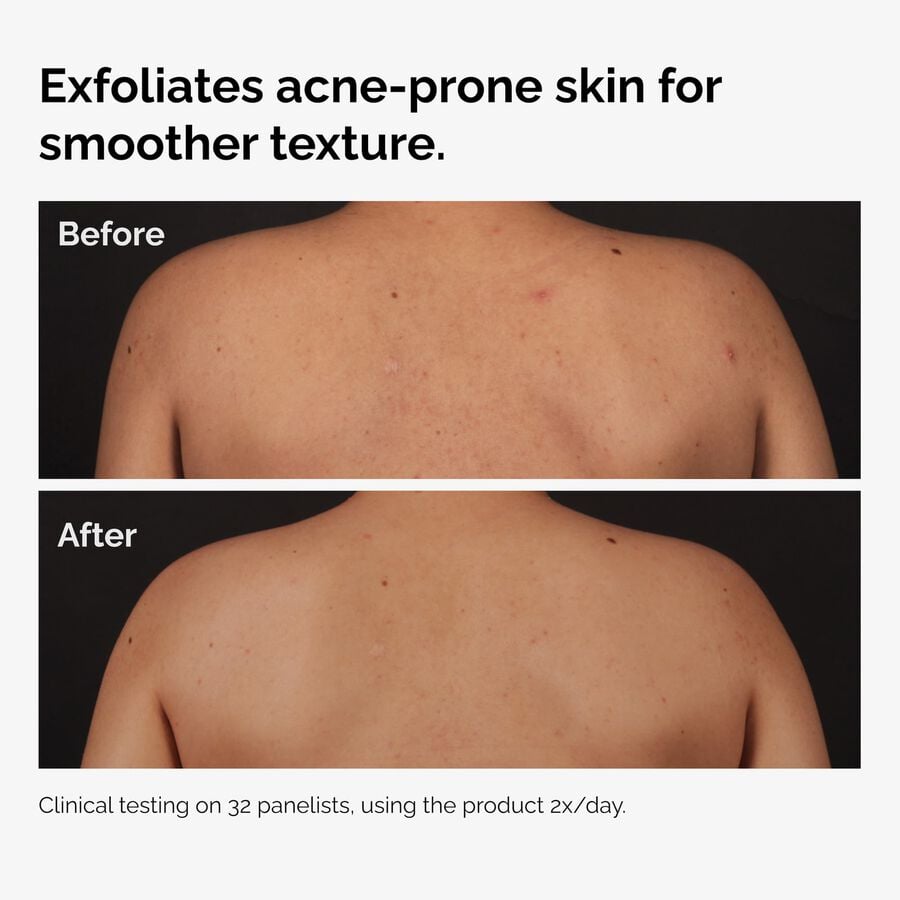 salicylic-acid-0-5-body-serum-y5 ord-salicylic-acid-body-serum-before-after-graphic-NA.jpg