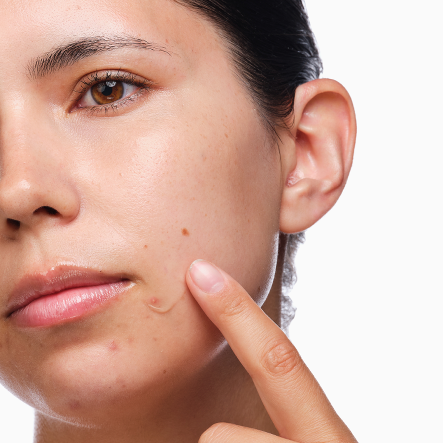 the-acne-set-o1 rdn-the-acne-set-application.png